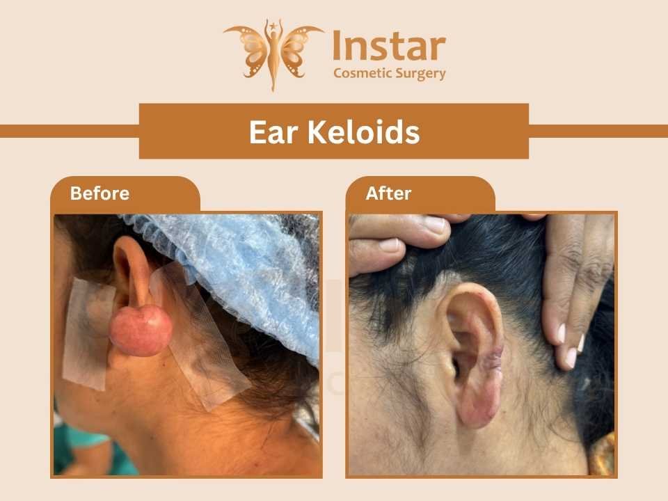 Ear Keloids-1